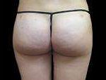 Liposuction Before & After Patient #2085