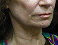 Neck Lift Before & After Patient #2664