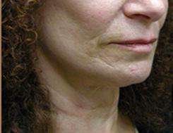 Neck Lift Before & After Patient #2664