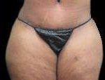 Tummy Tuck Before & After Patient #3267