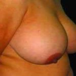 Breast Reduction Before & After Patient #1376