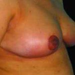 Breast Reduction Before & After Patient #1376
