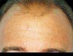 Hair Restoration Before & After Patient #1821