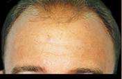 Hair Restoration Before & After Patient #1821