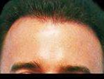 Hair Restoration Before & After Patient #1821