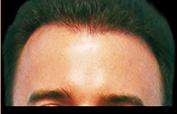 Hair Restoration Before & After Patient #1821