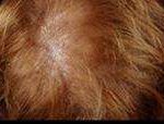 Hair Restoration Before & After Patient #1829