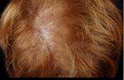 Hair Restoration Before & After Patient #1829