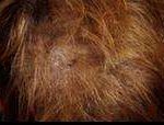 Hair Restoration Before & After Patient #1829