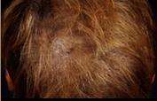 Hair Restoration Before & After Patient #1829