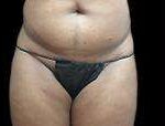Liposuction Before & After Patient #2051