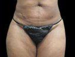 Liposuction Before & After Patient #2051