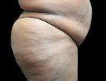 Liposuction Before & After Patient #2071