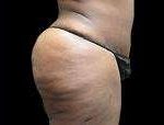 Liposuction Before & After Patient #2071