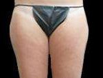 Liposuction Before & After Patient #2085
