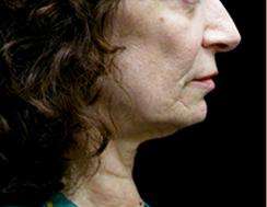 Neck Lift Before & After Patient #2664