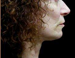 Neck Lift Before & After Patient #2664