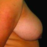 Breast Reduction Before & After Patient #1376