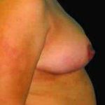 Breast Reduction Before & After Patient #1376