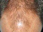 Hair Restoration Before & After Patient #1821
