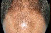 Hair Restoration Before & After Patient #1821