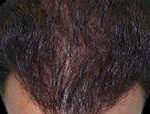 Hair Restoration Before & After Patient #1821