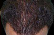 Hair Restoration Before & After Patient #1821