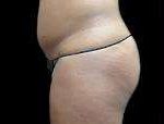 Liposuction Before & After Patient #2051