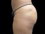 Liposuction Before & After Patient #2051