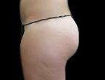 Liposuction Before & After Patient #2085