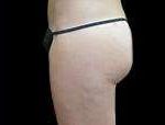 Liposuction Before & After Patient #2085