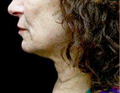Neck Lift Before & After Patient #2664