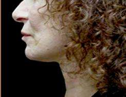 Neck Lift Before & After Patient #2664