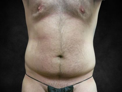 Male Body Contouring Before & After Patient #8852