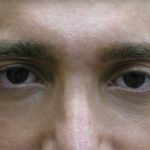 Male Facial Aesthetic Surgery Before & After Patient #8819