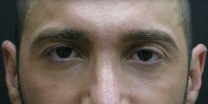 Male Facial Aesthetic Surgery Before & After Patient #8819