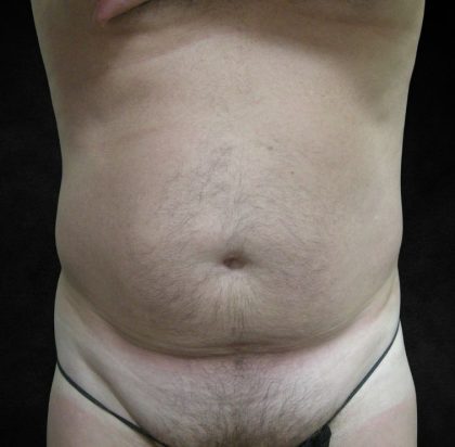 Male Body Contouring Before & After Patient #8850