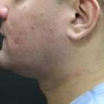 Male Facial Aesthetic Surgery Before & After Patient #8822