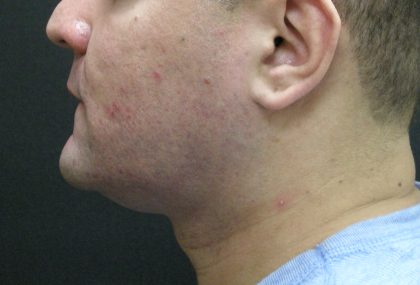 Male Facial Aesthetic Surgery Before & After Patient #8822