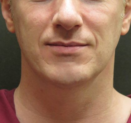 Male Facial Aesthetic Surgery Before & After Patient #8823