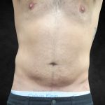 Male Body Contouring Before & After Patient #8852