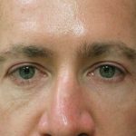 Male Facial Aesthetic Surgery Before & After Patient #8818