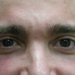 Male Facial Aesthetic Surgery Before & After Patient #8819