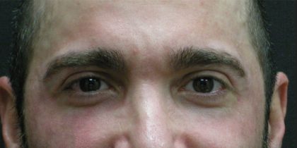 Male Facial Aesthetic Surgery Before & After Patient #8819