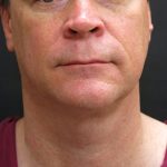 Male Facial Aesthetic Surgery Before & After Patient #8820