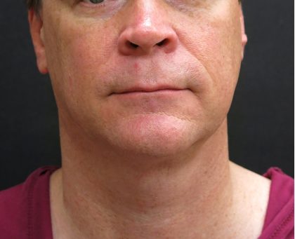 Male Facial Aesthetic Surgery Before & After Patient #8820