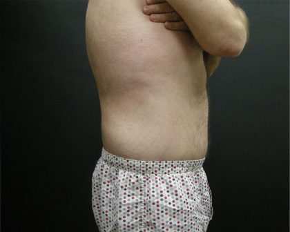 Male Body Contouring Before & After Patient #8849