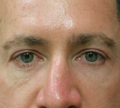 Male Facial Aesthetic Surgery Before & After Patient #8818