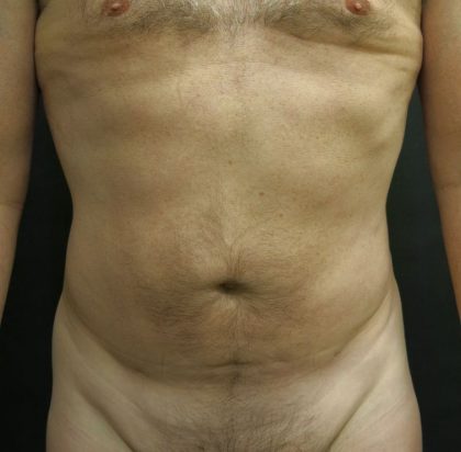 Male Body Contouring Before & After Patient #8850