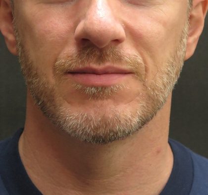 Male Facial Aesthetic Surgery Before & After Patient #8823